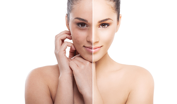 skin peel1 1