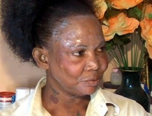 Skin lightening damage ireportstv — image courtesy of ireportstv.co