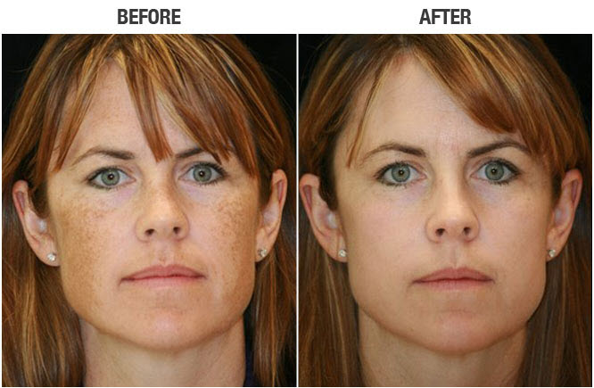 IPL before and after urbanradiance — image courtesy of urbanradiance.com