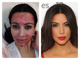 Vampire Facial Kim K
