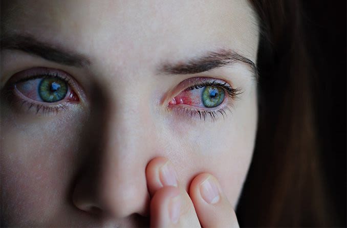 Eyes red allaboutvision — image courtesy of allaboutvision.com